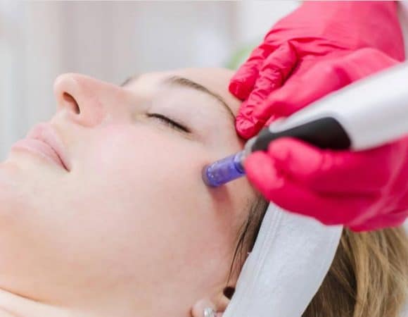 Fractional RF Microneedling Facial Services
